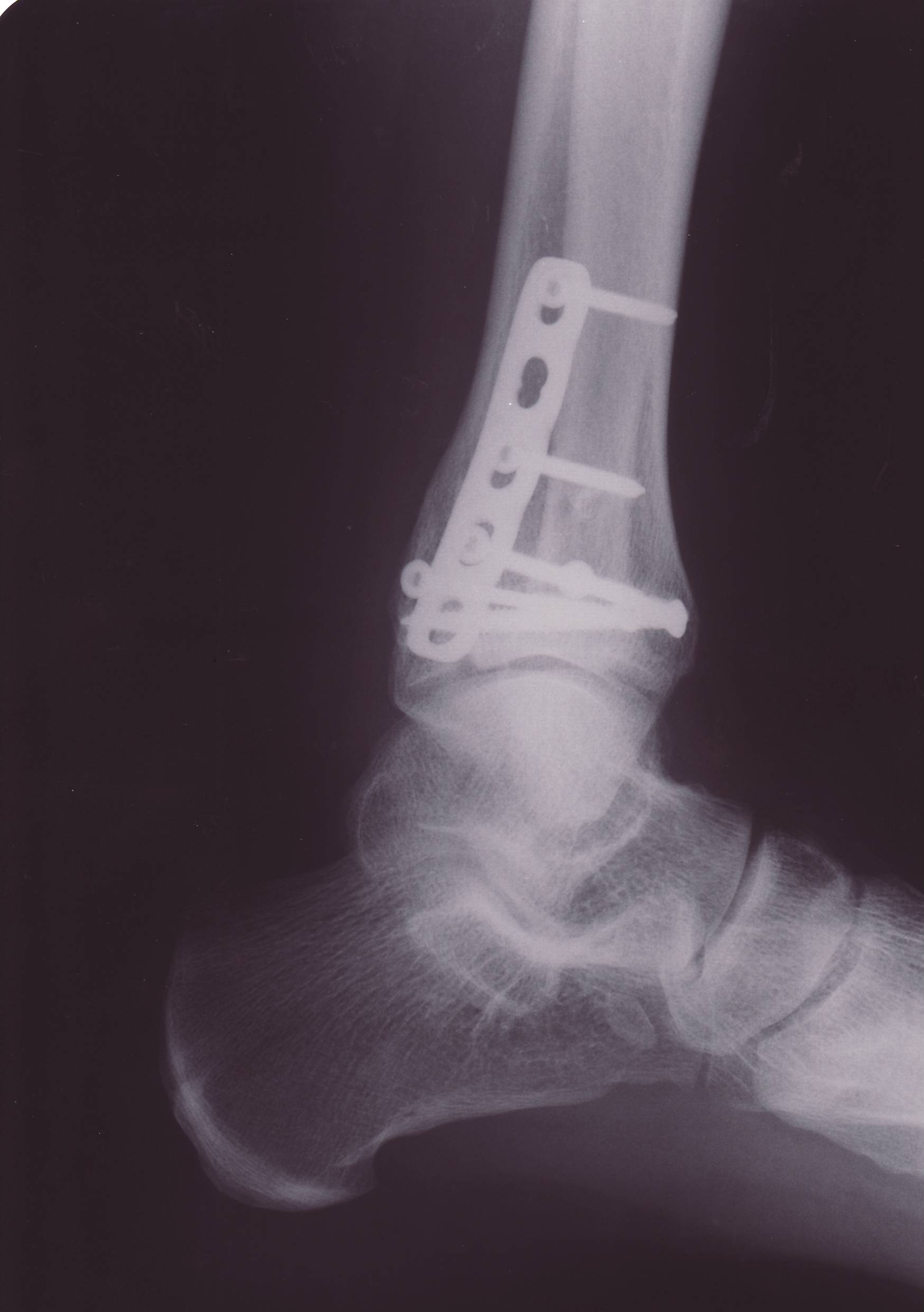 R�ntgenbild.Sprunggelenk1.JPG